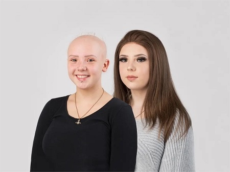 chemotherapy-patients-hair-loss