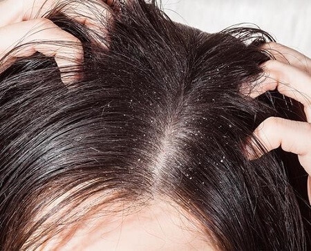 dry-scalp