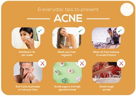 how-to-treat-acne