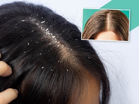 How To Effectively Get Rid Of Scalp Buildup?